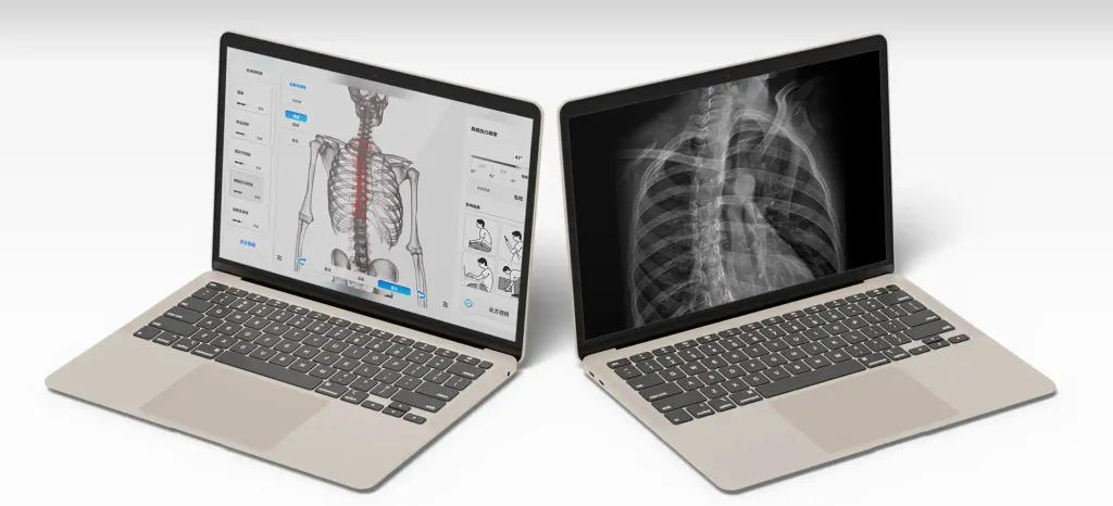 Porovnanie röntgenovej snímky a digitálnej 3D analýzy držania tela v softvéri MOTI Physio