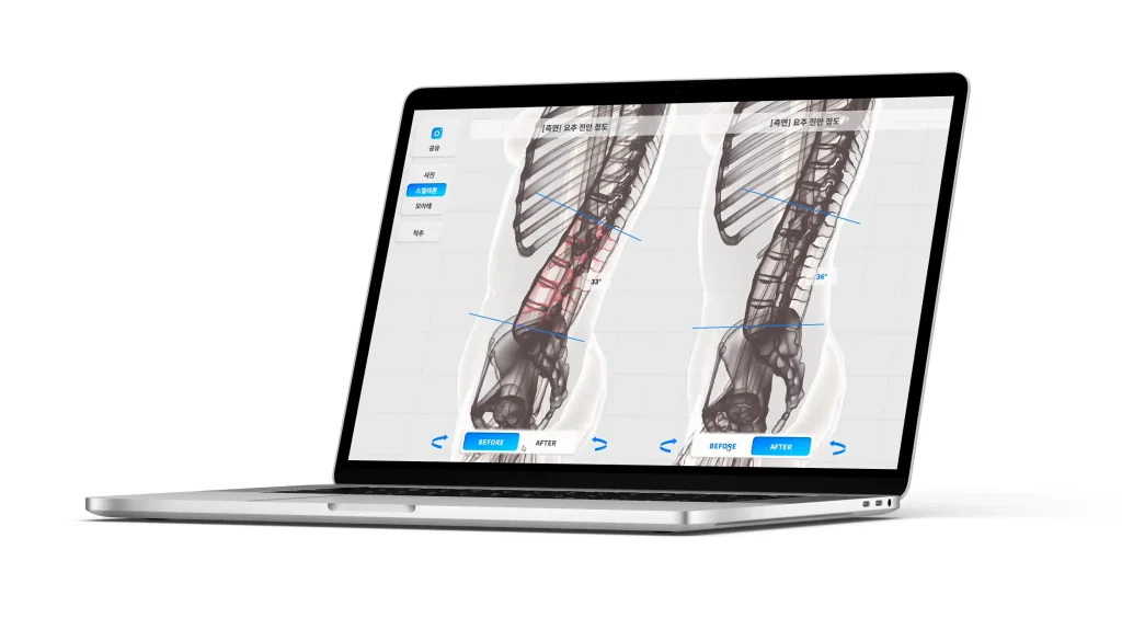 Porovnanie držania tela pred a po terapii na monitore s 3D vizualizáciou chrbtice v softvéri MOTI Physio